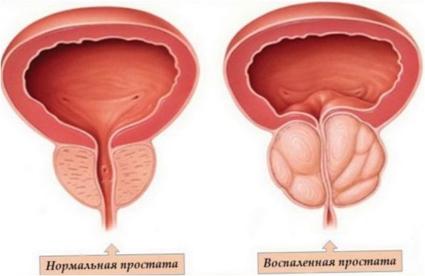 Zapalenie gruczołu krokowego